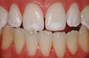 Preventing orthodontic white spot lesions