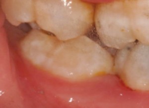 FIGURE 12. Photograph after uprighting #31 with fixed appliances.