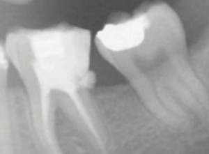 FIGURE 7. The location of this caries lesion makes restoration difficult.