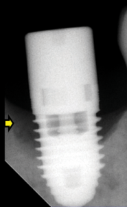 FIGURE 3B. Bone loss is identifiable around the fixture when compared to the adjacent crest.