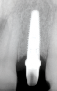 FIGURE 3C. Normal bone height is within 2 mm of the surrounding crest.