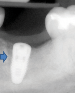 FIGURE 3A. Even without a baseline radiograph for comparison, bone loss around an implant fixture can be identified as a funnel-shaped radiolucency around the fixture.