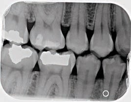 moderate periodontitis radiograph