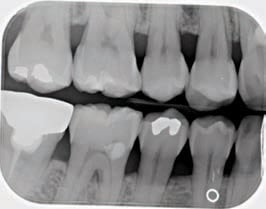 moderate periodontitis radiograph