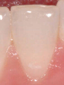 FIGURE 1. This lesion, which only appears when the surface is dry, is classified as a Code 1 in the International Caries Detection and Assessment System.