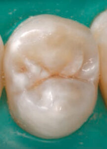 FIGURE 3. When this lesion is dry, the discoloration is confined to the pit and fissure area. Under the International Caries Detection and Assessment System, it is a Code 1.