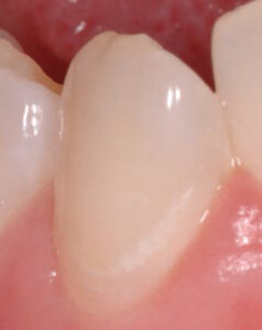 FIGURE 5. Although this lesion is white, it is located above the gingival margin and is hard, shiny, and intact, making it an inactive lesion.