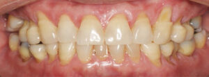 FIGURE 1. Noncarious cervical lesions are present on the buccal of upper and lower teeth.