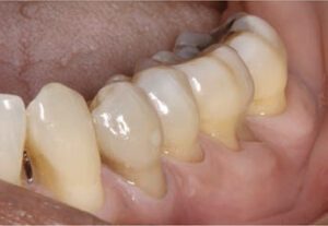 FIGURE 2. This patient has severe noncarious cervical lesions.
