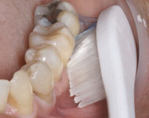 FIGURE 3. Toothbrush abrasion may be part of the multifactorial etiology of noncarious cervical lesions.