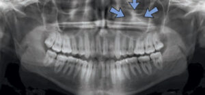 FIGURE 8. This antral pseudocyst arises from the floor of the left maxillary sinus as a dome-shaped radiopacity of soft tissue density.