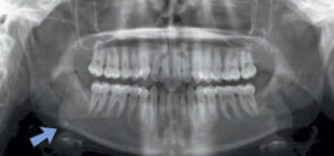 FIGURE 9. A sialolith presents as a small, round-like radiopacity uperimposed on the right mandibular inferior border.