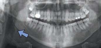 FIGURE 11. A calcified stylohyoid ligament is often seen in X-rays as part of the stylohyoid complex.