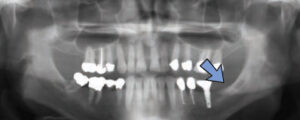 FIGURE 2. This osteoporotic bone marrow defect in the area of tooth #17 and tooth #18 has persisted long after tooth extraction.