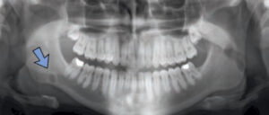 FIGURE 3. . The location of radiolucencies can support the diagnosis of a Stafne defect, as seen here in the right mandible.