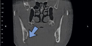 FIGURE 4. This coronal view of a Stafne defect demonstrates the mandibular defect (not the same patient as seen in Figure 3).