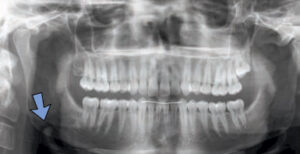 FIGURE 5. This homogenous radiopacity is a benign idiopathic osteosclerosis, or dense bone island.