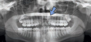 FIGURE 6. This compound odontoma features multiple radiopaque structures, resembling small misshapen teeth, surrounded by a radiolucent halo.