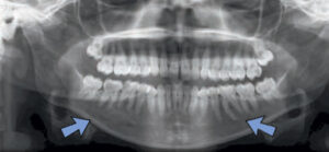 FIGURE 7. This condensing osteitis is associated with a necrotic pulp in tooth #30. In the left mandible, there is an idiopathic osteosclerosis at the mesial root tooth #19.