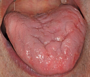 FIGURE 1. In this case of geographic tongue, the clinical signs, which include red patches surrounded by thin white-to-yellow borders, are minimally evident.