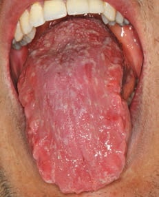 FIGURE 2. The clinical signs of geographic tongue are more pronounced in this example.