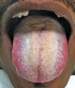 FIGURE 3. This patient has hairy tongue with tan and white papillae. The condition can also present with brown or black papillae.