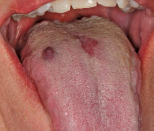 FIGURE 4. Median rhomboid glossitis presents as a zone of depapillation of the filiform papillae, along the midline of the posterior dorsal surface of the tongue.