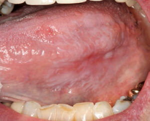 FIGURE 5. One of the most common presentations of oral lichen planus, this example demonstrates its reticular, white, lacy pattern.