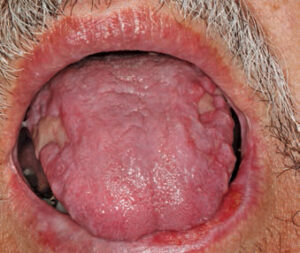 FIGURE 6. Erosive oral lichen planus presents as erythema and ulcerations with radiating striae.