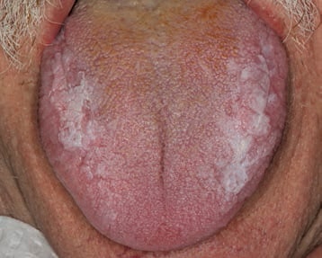 FIGURE 7. The white, elevated patches of plaque-like oral lichen planus are less prevalent.