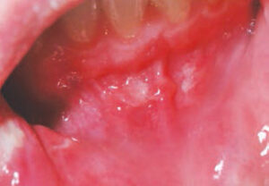 FIGURE 1. Recurrent aphthous ulcerations in the vestibule can be an early sign of Crohn’s disease.