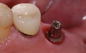 FIGURE 1A. Cemented implant crown removed. Residual excess cement is present in the sulcular tissue.