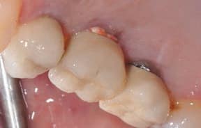 FIGURE 2A. A new patient presented for routine examination. Cement residue was seen around the maxillary molar implant.