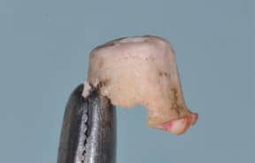 FIGURE 2C. The cement extrusion is clearly visible as a ledge or overhang into the periimplant soft tissues.