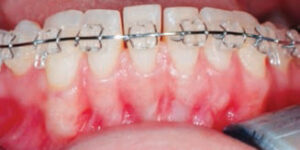 FIGURE 1. As depicted in this presurgical image, the orthodontic appliances are in place and the teeth have been aligned. Note the thin periodontium and minimal keratinized gingiva.