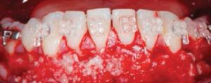 FIGURE 3. An allograft is placed over the exposed roots and corticotomies. Another layer of xenograft is added on top to obtain at least 2 mm of thickness.