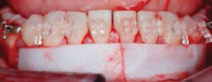FIGURE 4. The grafted areas are covered with a long-lasting collagen resorbable membrane.