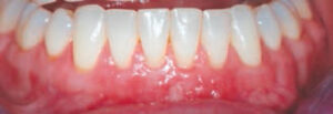 FIGURE 6B. A year after completion of orthodontic therapy, flap elevation demonstrates a significant increase of buccal bone height and thickness. Notice there is no loss of interproximal papilla height.