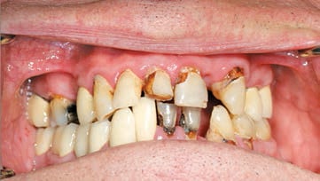 FIGURE 1. Older adult patient with severe root caries.