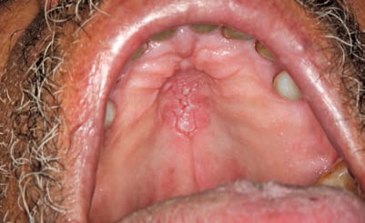 FIGURE 3. Candidiasis affecting the palate.