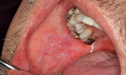 FIGURE 5. Erosive oral lichen planus.