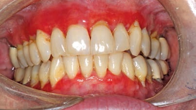 erosive lichen planus gingiva