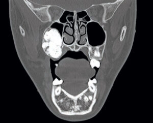 FIGURE 2. An axial computed tomography scan showing a radiopaque mass extending and encroaching upon the posterior wall of the maxillary sinus.