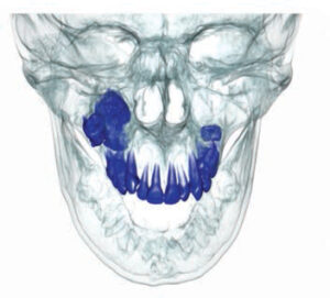 FIGURE 5. This computed tomography reconstruction shows a radiopaque lesion associated with an impacted molar.