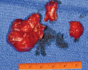 FIGURE 7. The lesion after it was surgically removed.