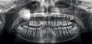 FIGURE 1. This panoramic radiograph shows a radiopaque lesion of the right maxilla associated with an impacted maxillary third molar and second molar.