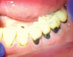 FIGURE 3. Silver diamine fluoride was used to arrest primary and secondary root caries in this older adult. The balding of the tongue and caries resulted from xerostomia. The black, discolored surfaces do not show when speaking or smiling.