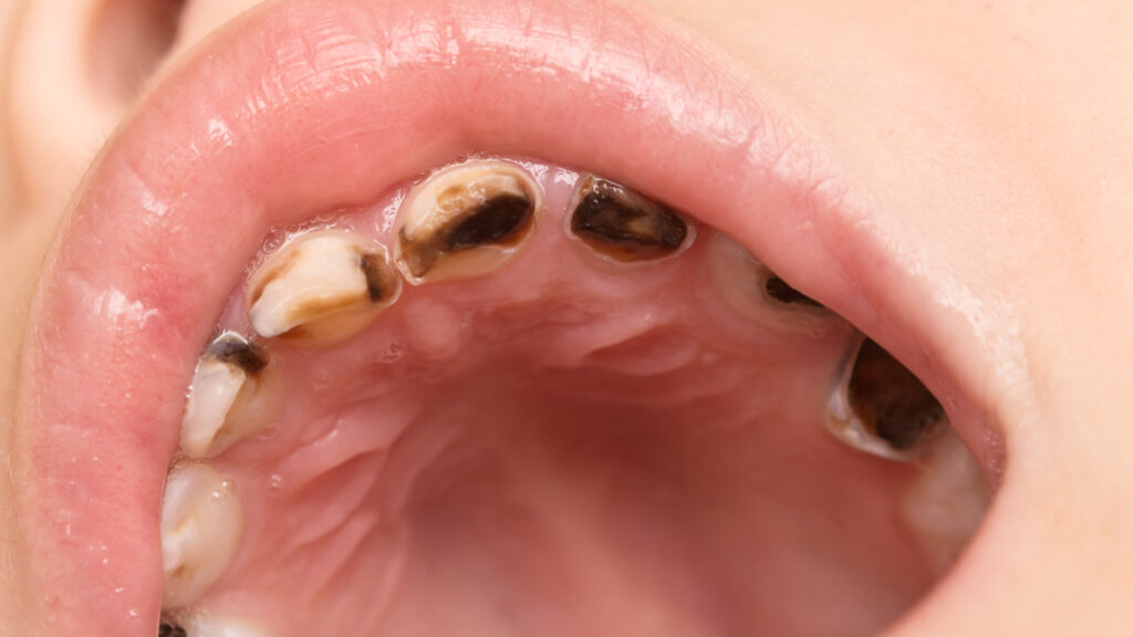 Study Examines Accuracy of Risk Assessment in Caries Management Decisions in Dentistry
