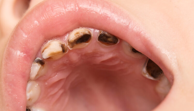 study-examines-accuracy-of-risk-assessment-in-caries-management