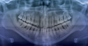 FIGURE 1. This panoramic radiograph of a 33-year-old male patient shows the presence of multiple periodontal abscesses and generalized, moderate to severe aggressive periodontal disease. It provides radiographic evidence of subgingival etiology and periradicular and crestal radiolucencies, indicating generalized vertical and horizontal bone loss.